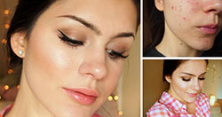 5 consejos de maquillaje para pieles propensas al acné y con cicatrices: 