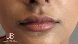 Descubre los rellenos labiales Cardiff: 