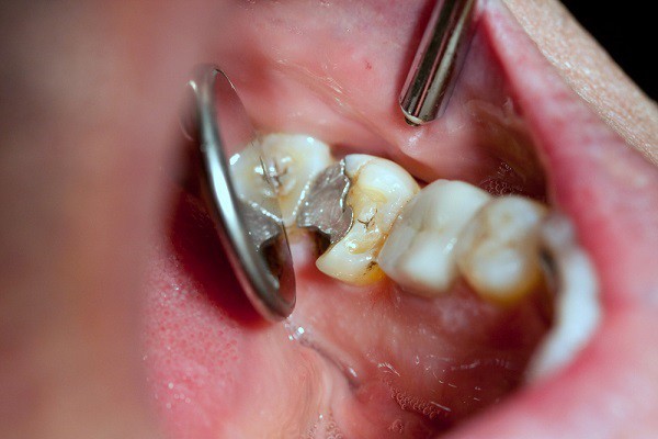 Extracciones dentales Christchurch
