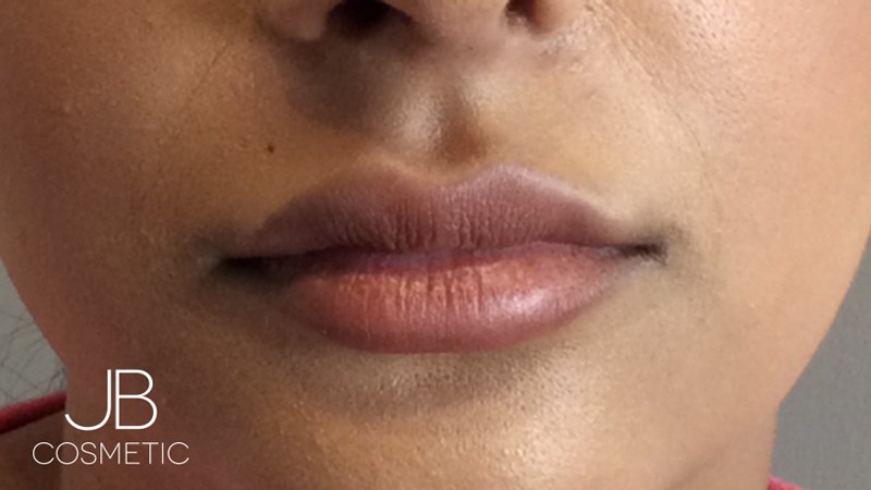 Descubre los rellenos labiales Cardiff